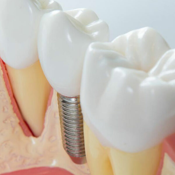 4 practical tips to maintain dental implants for seniors