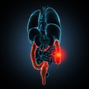 Crohn’s Disease Common Signs and Symptoms