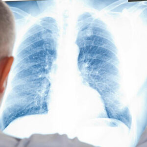 A few things you should know about mesothelioma cancer