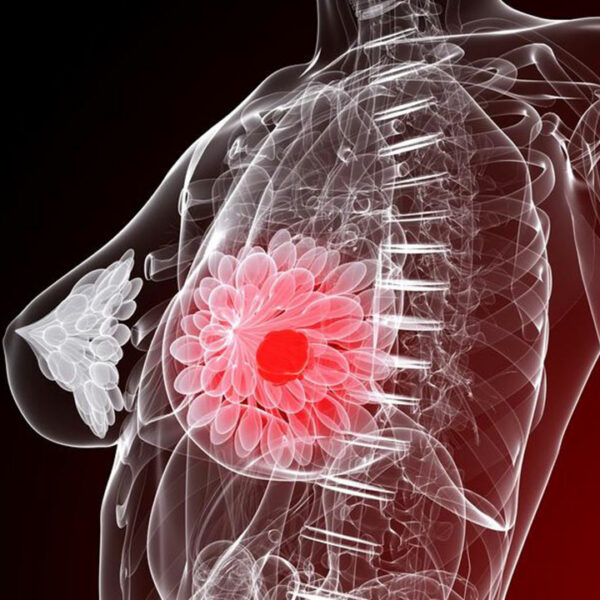 Five things you need to know about breast cancer