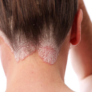 Know the skin ailment: Scalp psoriasis