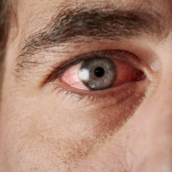 Sjogren&#8217;s Syndrome- Causes and Symptoms