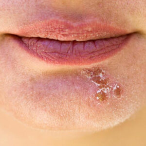 Popular essential oils to bid goodbye to cold sores