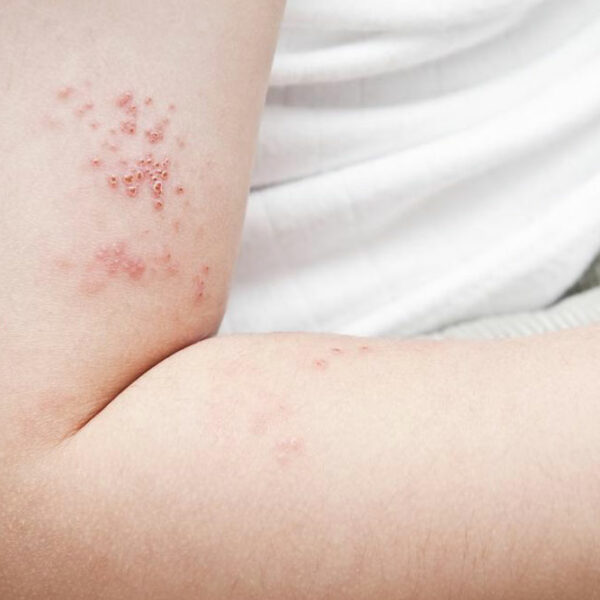 Prevent yourself from shingles before it infects you