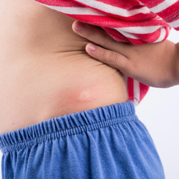 5 Useful Things to Know about Hidradenitis Suppurativa