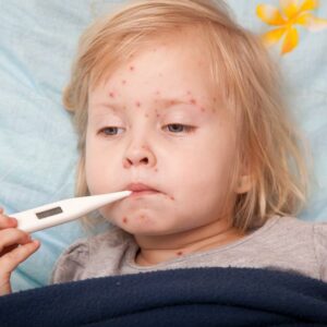 Causes, Symptoms, and Treatment of Measles