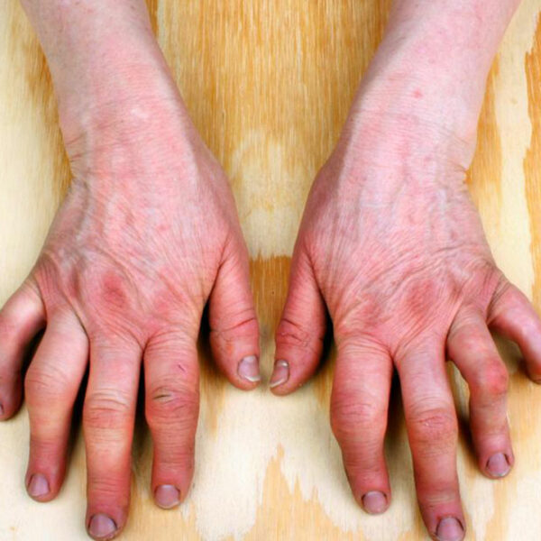 A Brief Overview of Rheumatoid Arthritis