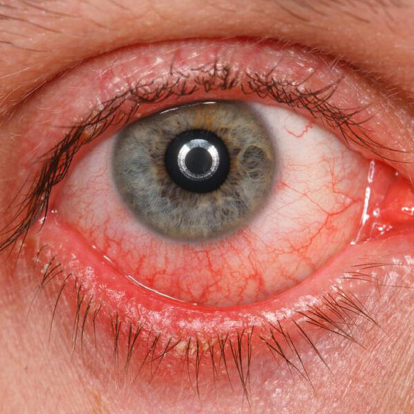 A Few Common Symptoms, Causes, And Treatments of Pink Eyes