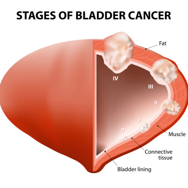 A Guide To Understanding Bladder Cancer