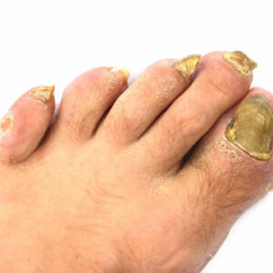 An Effective Way to Treat Toenail Fungus &#8211; Hydrogen Peroxide