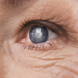 All You Need to Know about Cataract