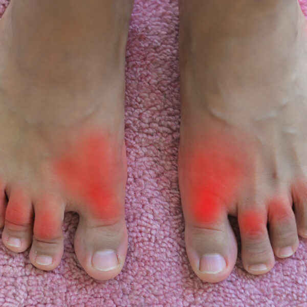 All you need to Know about Gout and Its Treatment