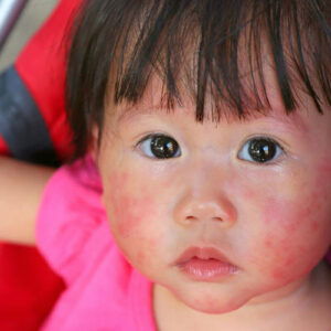 Do Not Neglect These Child Allergy Symptoms