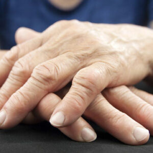 Easy Ways to Manage Psoriatic Arthritis