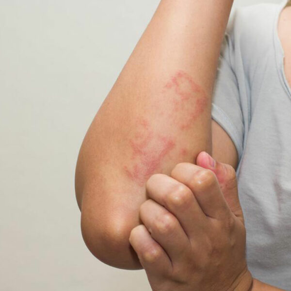 Eczema &#8211; Types, Causes, Symptoms, and Treatment