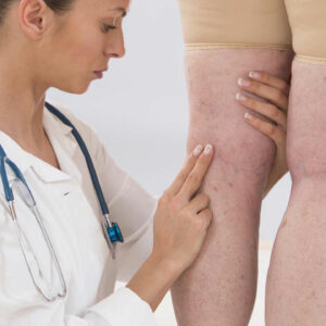 Effective Treatment for Varicose Veins