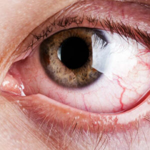 Few Vital Causes and Cure of Chronic Dry Eye