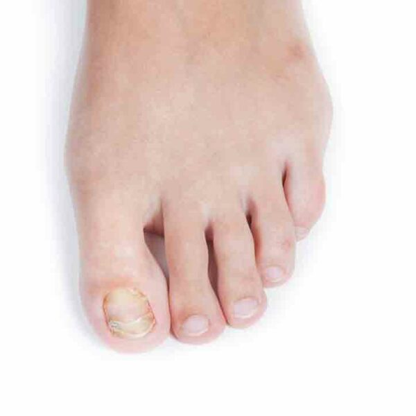 How to Treat Fungal Infections in the Toenails