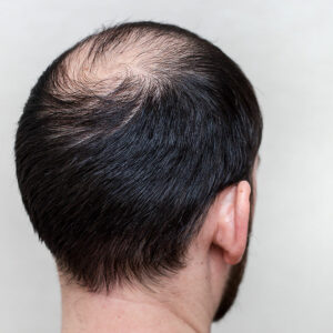 Male hair loss and its various aspects