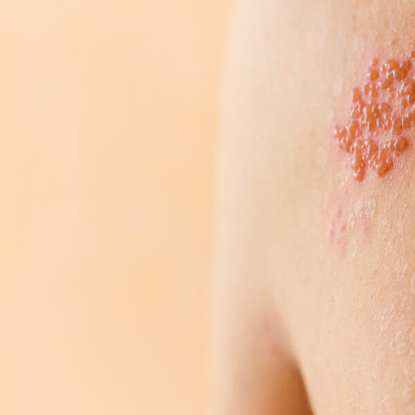 Symptoms and causes of shingles