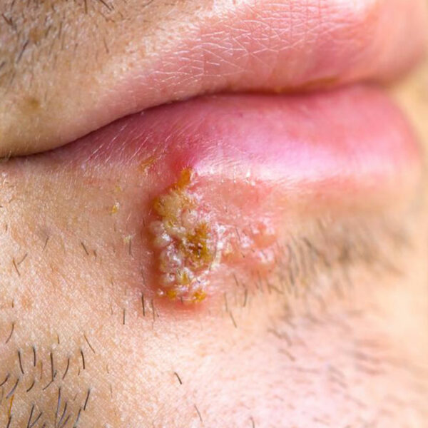 Ways to Get Rid of Cold Sores