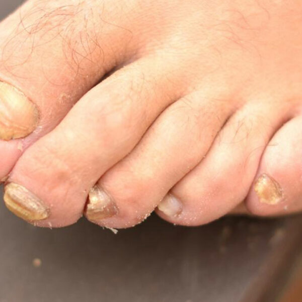 Toenail Fungus &#8211; Causes, Symptoms and Treatment