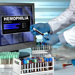 The Diagnosis and Prognosis of Hemophilia