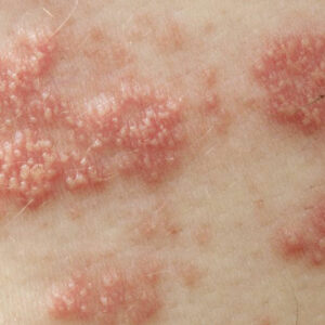 The Treatments for Shingles You Should Know