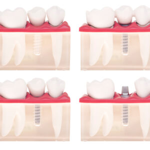 The various types of crowns and caps